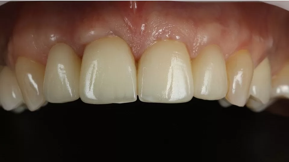 Красивая и надежная имплантация Straumann четырех передних верхних зубов